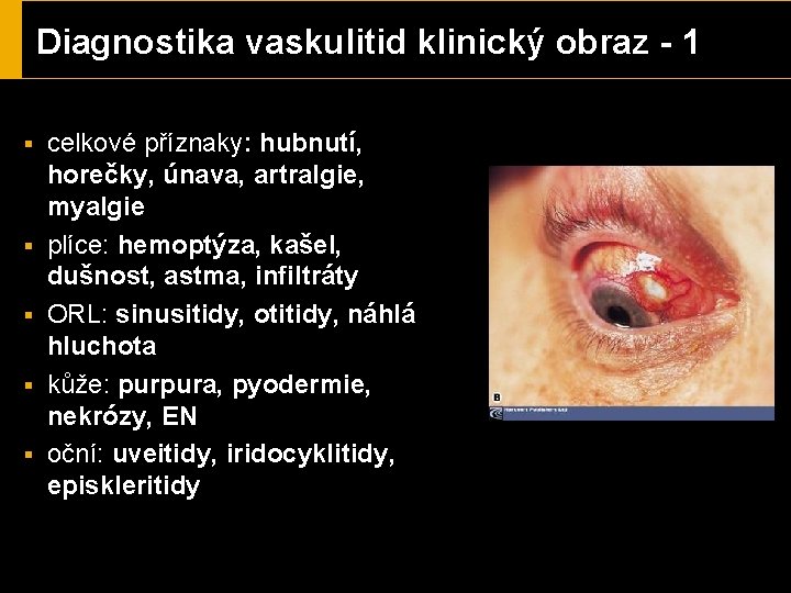 Diagnostika vaskulitid klinický obraz - 1 § § § celkové příznaky: hubnutí, horečky, únava,