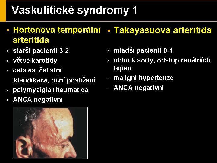 Vaskulitické syndromy 1 § Hortonova temporální § Takayasuova arteritida starší pacienti 3: 2 •