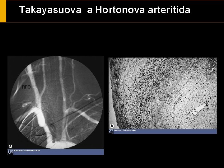 Takayasuova a Hortonova arteritida 