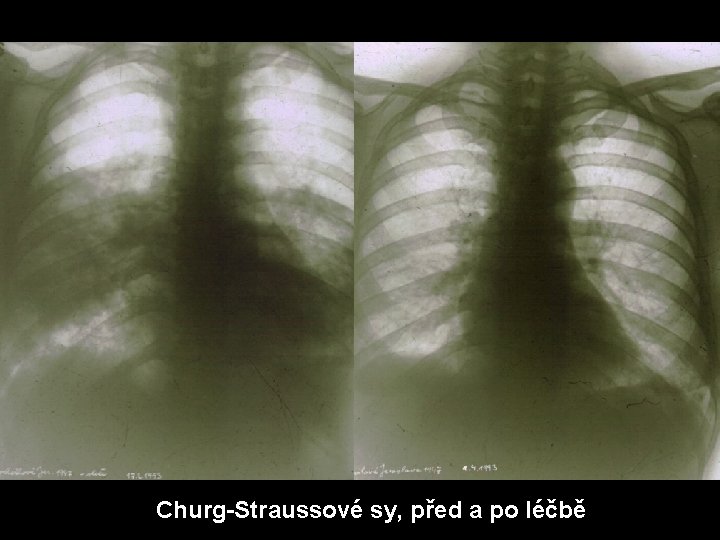  Churg-Straussové sy, před a po léčbě 