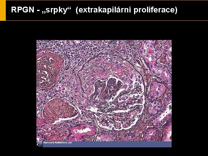 RPGN - „srpky“ (extrakapilární proliferace) 