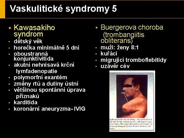 Vaskulitické syndromy 5 § Kawasakiho syndrom dětský věk horečka minimálně 5 dní oboustranná konjunktivitida