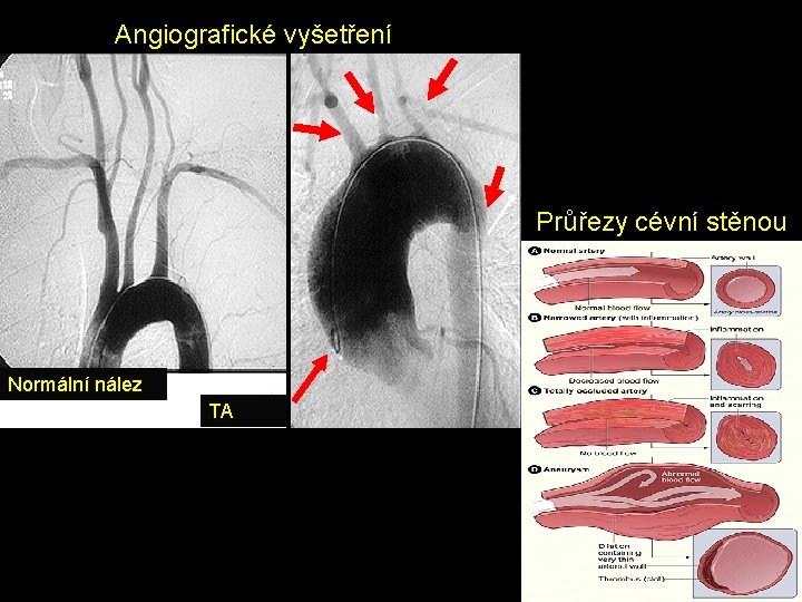 Angiografické vyšetření Průřezy cévní stěnou Normální nález TA 
