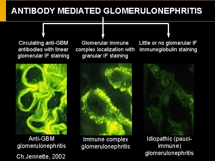 ANTIBODY MEDIATED GLOMERULONEPHRITIS Circulating anti-GBM antibodies with linear glomerular IF staining Anti-GBM glomerulonephritis Ch.