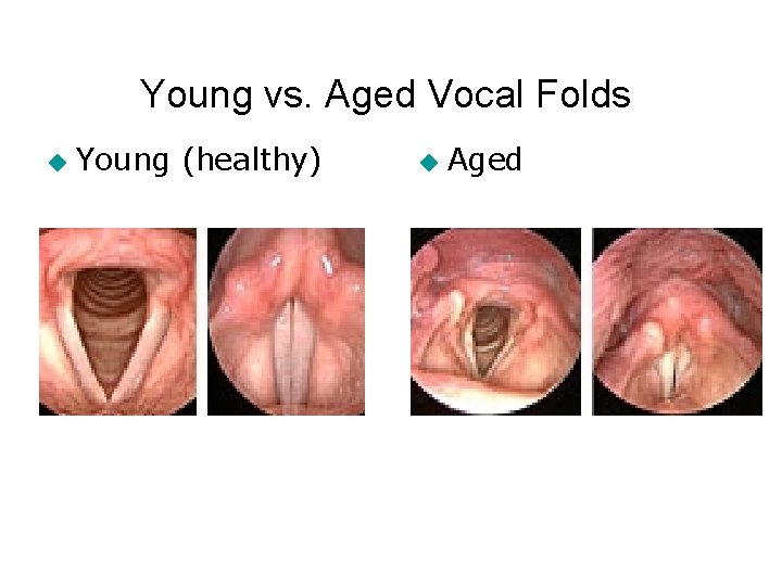 Young vs. Aged Vocal Folds ◆ Young (healthy) ◆ Aged Young vs. Aged Vocal Folds ◆ Young (healthy) ◆ Aged