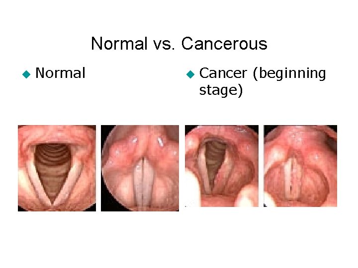 Normal vs. Cancerous ◆ Normal ◆ Cancer (beginning stage) Normal vs. Cancerous ◆ Normal ◆ Cancer (beginning stage)
