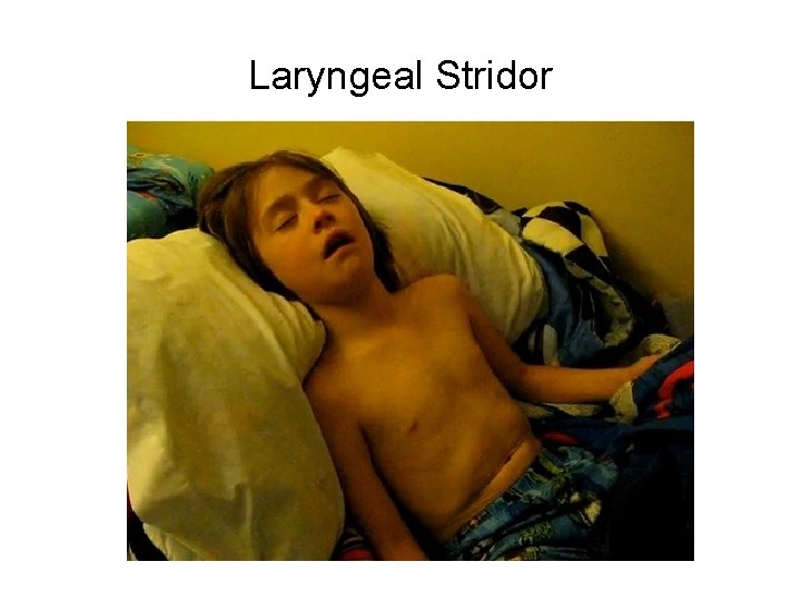 Laryngeal Stridor Laryngeal Stridor