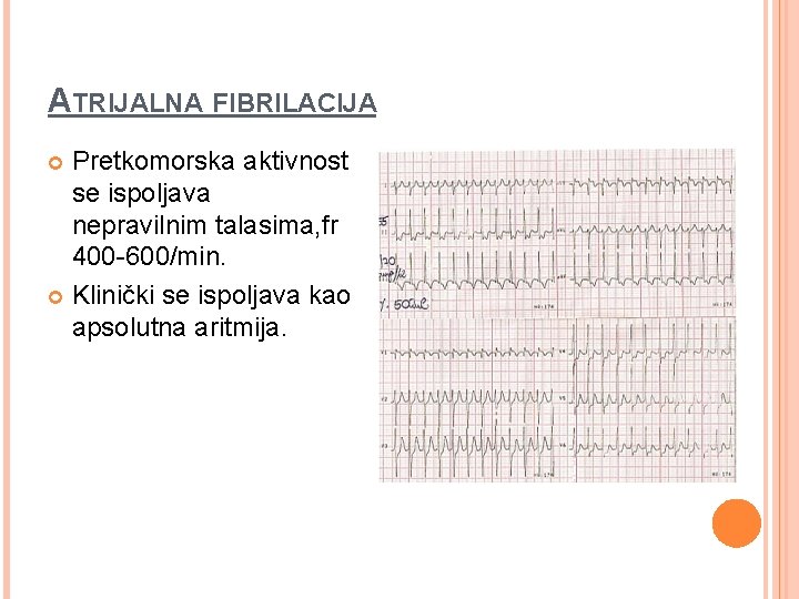 ATRIJALNA FIBRILACIJA Pretkomorska aktivnost se ispoljava nepravilnim talasima, fr 400 -600/min. Klinički se ispoljava