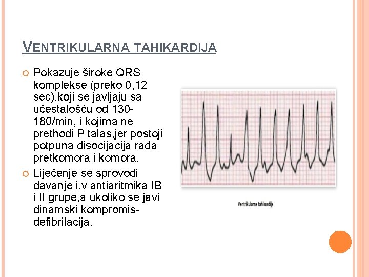 VENTRIKULARNA TAHIKARDIJA Pokazuje široke QRS komplekse (preko 0, 12 sec), koji se javljaju sa