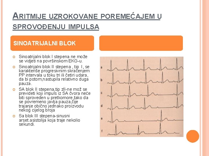 ARITMIJE UZROKOVANE POREMEĆAJEM U SPROVOĐENJU IMPULSA SINOATRIJALNI BLOK Sinoatrijalni blok I stepena ne može