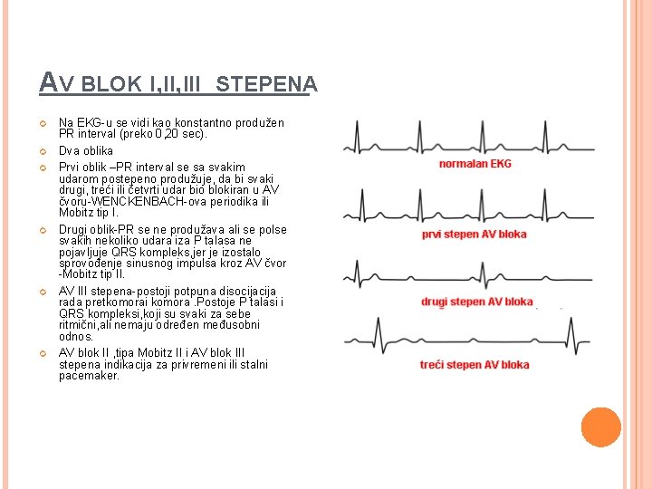 AV BLOK I, III STEPENA Na EKG-u se vidi kao konstantno produžen PR interval