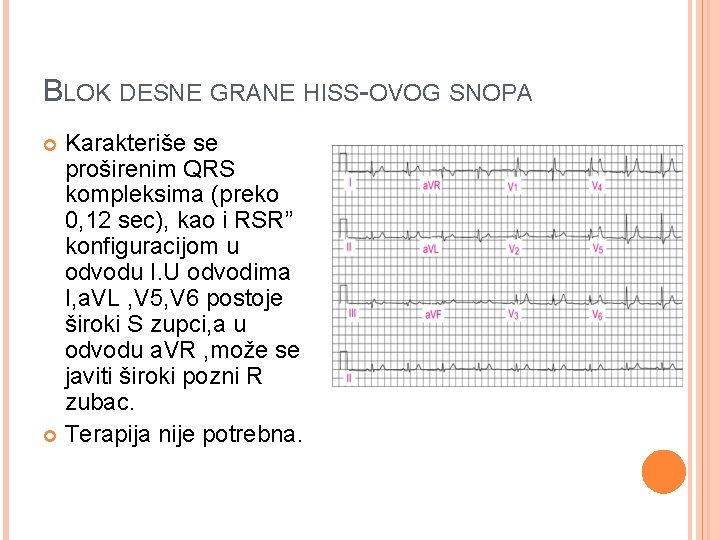 BLOK DESNE GRANE HISS-OVOG SNOPA Karakteriše se proširenim QRS kompleksima (preko 0, 12 sec),