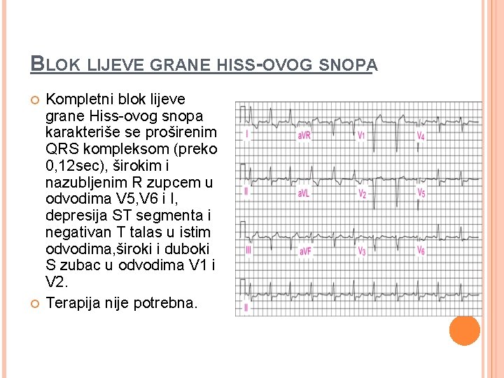 BLOK LIJEVE GRANE HISS-OVOG SNOPA Kompletni blok lijeve grane Hiss-ovog snopa karakteriše se proširenim