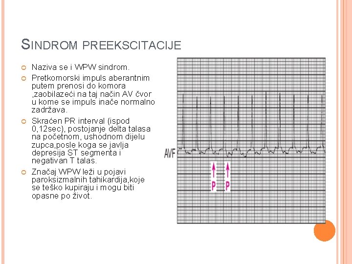 SINDROM PREEKSCITACIJE Naziva se i WPW sindrom. Pretkomorski impuls aberantnim putem prenosi do komora