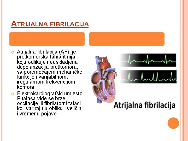 ATRIJALNA FIBRILACIJA Atrijalna fibrilacija (AF) je pretkomorska tahiaritmija koju odlikuje neuskladjena depolarizacija pretkomora, sa