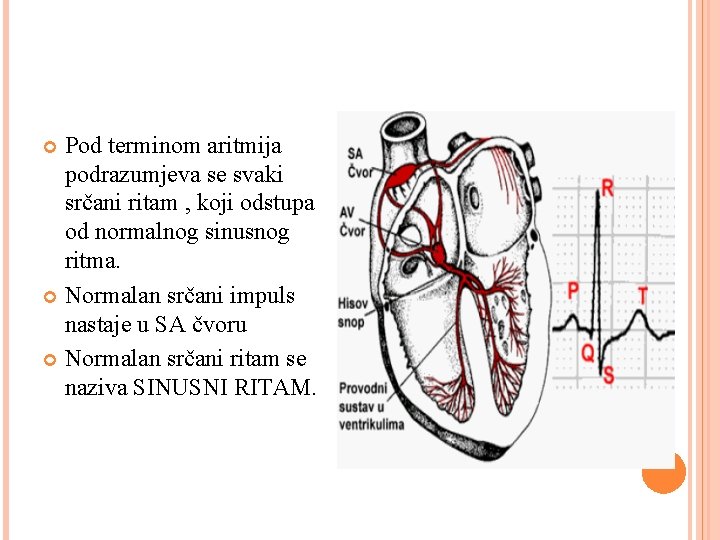Pod terminom aritmija podrazumjeva se svaki srčani ritam , koji odstupa od normalnog sinusnog