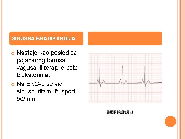 SINUSNA BRADIKARDIJA Nastaje kao posledica pojačanog tonusa vagusa ili terapije beta blokatorima. Na EKG-u
