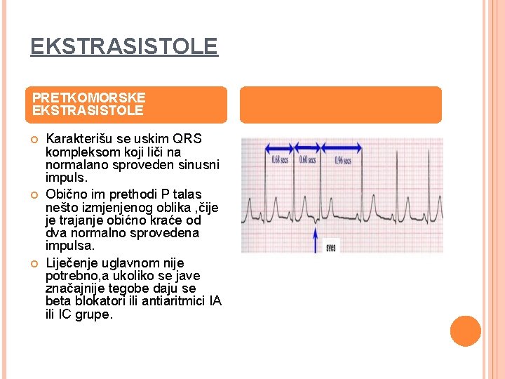 EKSTRASISTOLE PRETKOMORSKE EKSTRASISTOLE Karakterišu se uskim QRS kompleksom koji liči na normalano sproveden sinusni