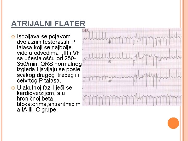 ATRIJALNI FLATER Ispoljava se pojavom dvofaznih testerastih P talasa, koji se najbolje vide u