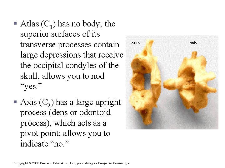 Cervical Vertebrae § Atlas (C 1) has no body; the superior surfaces of its