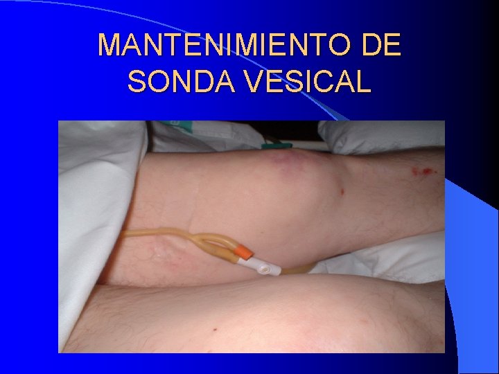 MANTENIMIENTO DE SONDA VESICAL 