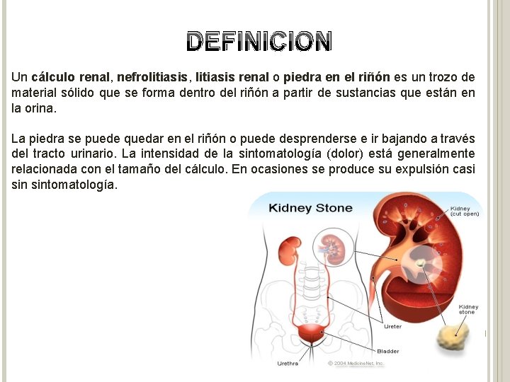 DEFINICION Un cálculo renal, nefrolitiasis, litiasis renal o piedra en el riñón es un