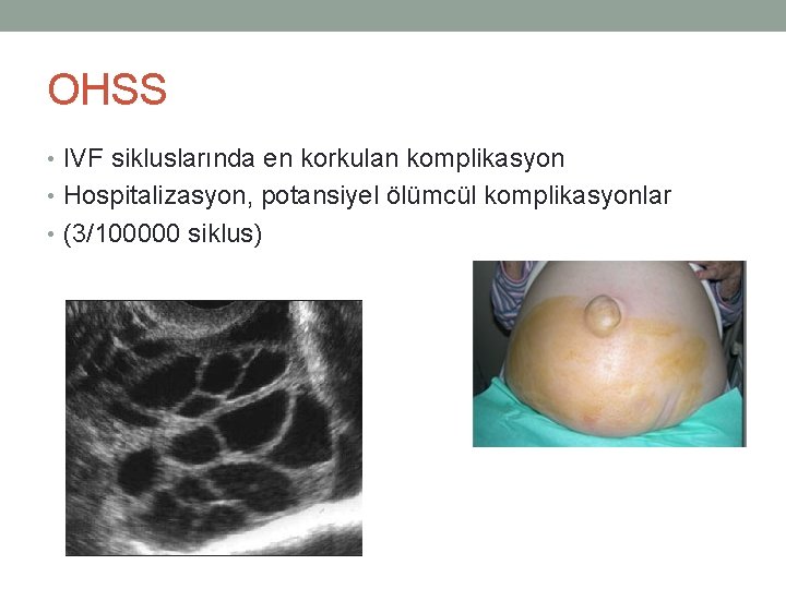 OHSS • IVF sikluslarında en korkulan komplikasyon • Hospitalizasyon, potansiyel ölümcül komplikasyonlar • (3/100000