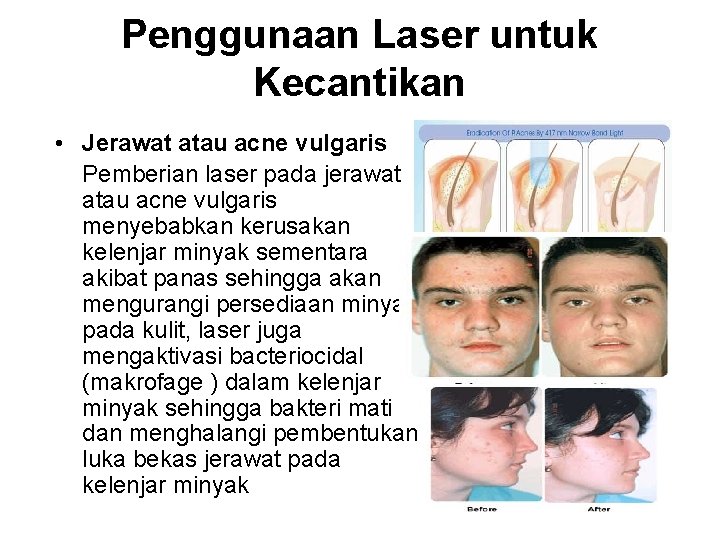Penggunaan Laser untuk Kecantikan • Jerawat atau acne vulgaris Pemberian laser pada jerawat atau