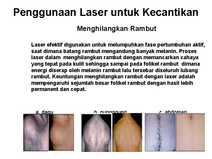 Penggunaan Laser untuk Kecantikan Menghilangkan Rambut Laser efektif digunakan untuk melumpuhkan fase pertumbuhan aktif,