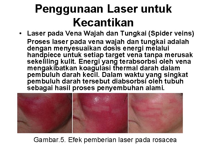 Penggunaan Laser untuk Kecantikan • Laser pada Vena Wajah dan Tungkai (Spider veins) Proses