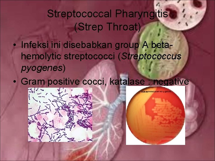 Streptococcal Pharyngitis (Strep Throat) • Infeksi ini disebabkan group A betahemolytic streptococci (Streptococcus pyogenes)