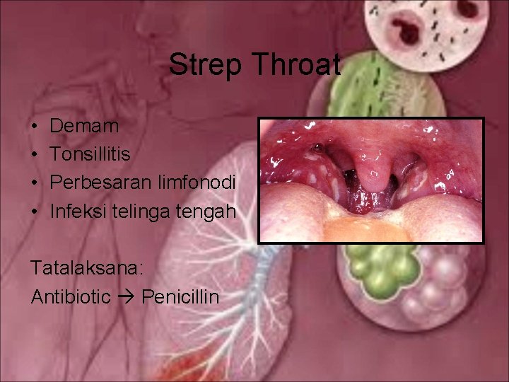 Strep Throat • • Demam Tonsillitis Perbesaran limfonodi Infeksi telinga tengah Tatalaksana: Antibiotic Penicillin