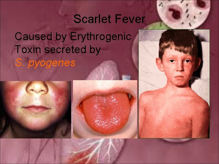 Scarlet Fever Caused by Erythrogenic Toxin secreted by S. pyogenes 