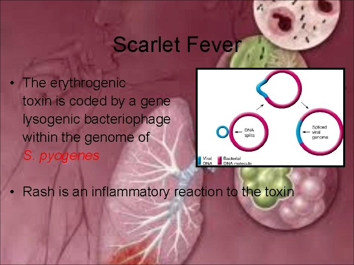 Scarlet Fever • The erythrogenic toxin is coded by a gene lysogenic bacteriophage within