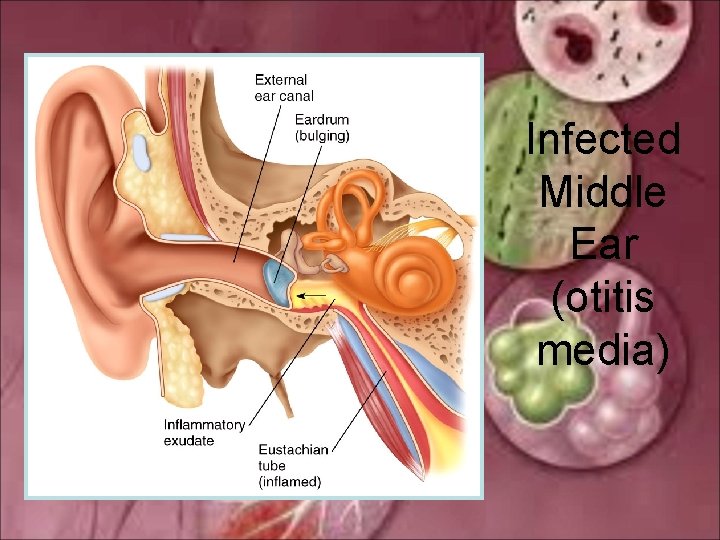 Infected Middle Ear (otitis media) 