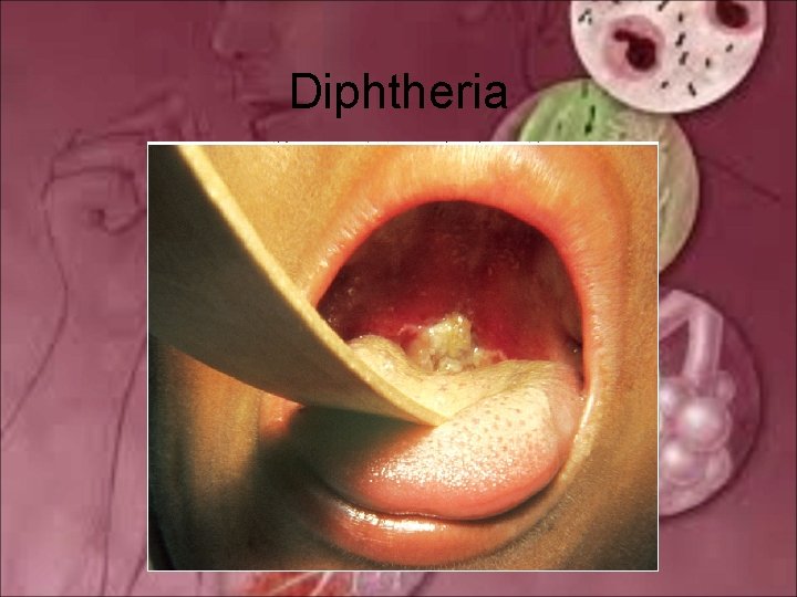 Diphtheria 