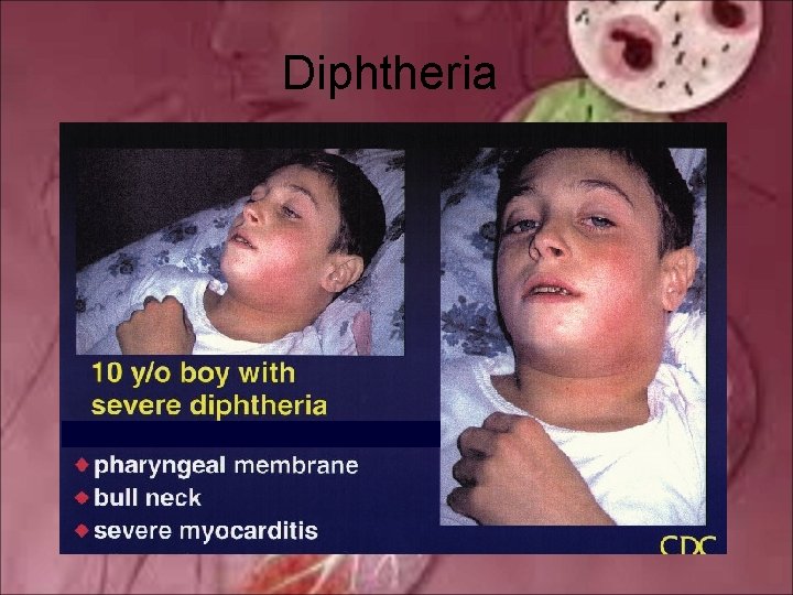 Diphtheria 