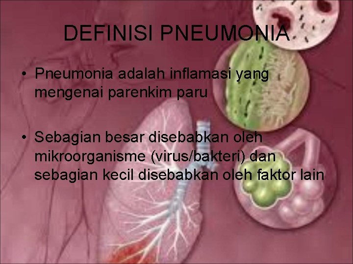 DEFINISI PNEUMONIA • Pneumonia adalah inflamasi yang mengenai parenkim paru • Sebagian besar disebabkan