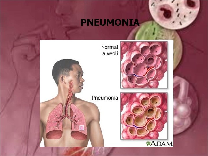 PNEUMONIA 