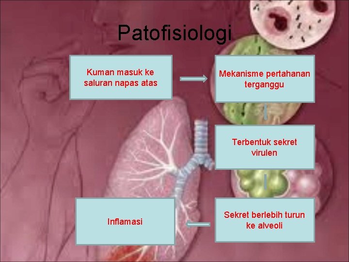 Patofisiologi Kuman masuk ke saluran napas atas Mekanisme pertahanan terganggu Terbentuk sekret virulen Inflamasi