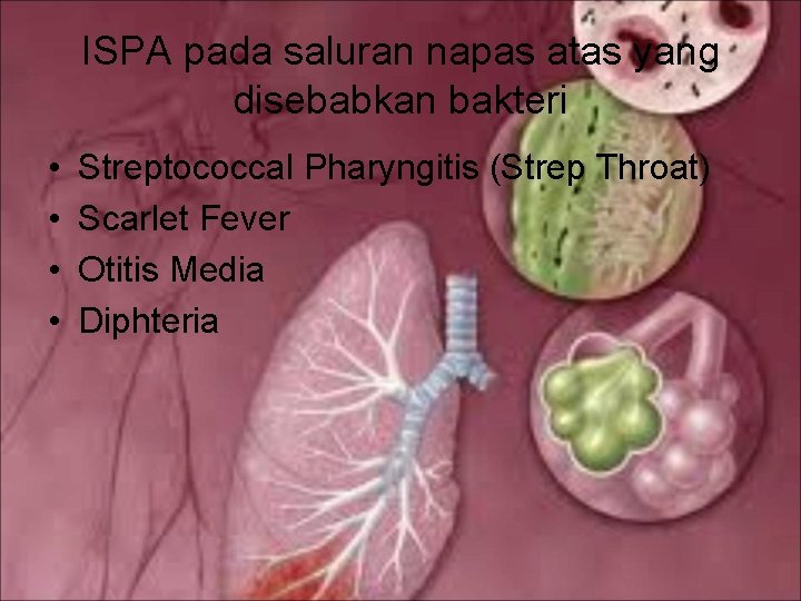 ISPA pada saluran napas atas yang disebabkan bakteri • • Streptococcal Pharyngitis (Strep Throat)