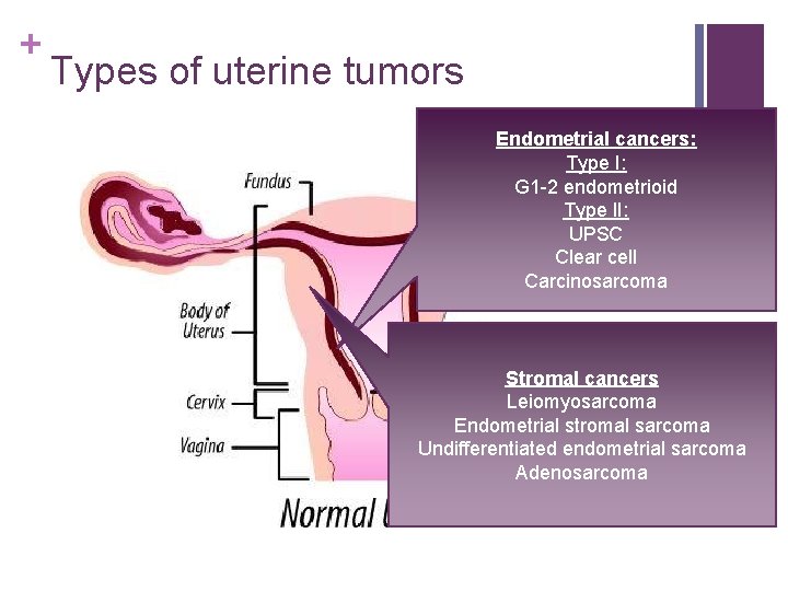 + Types of uterine tumors Endometrial cancers: Type I: G 1 -2 endometrioid Type