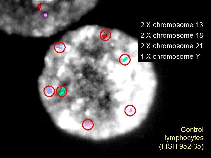 2 X chromosome 13 2 X chromosome 18 2 X chromosome 21 1 X 2 X chromosome 13 2 X chromosome 18 2 X chromosome 21 1 X
