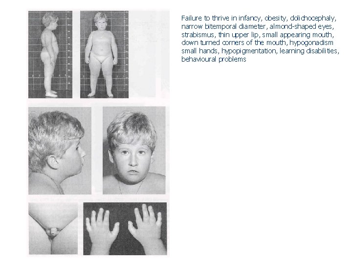 Failure to thrive in infancy, obesity, dolichocephaly, narrow bitemporal diameter, almond-shaped eyes, strabismus, thin Failure to thrive in infancy, obesity, dolichocephaly, narrow bitemporal diameter, almond-shaped eyes, strabismus, thin