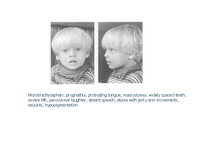 Microbrachycephaly, prognathia, protruding tongue, macrostomia, widely spaced teeth, severe MR, paroxysmal laughter, absent speech, Microbrachycephaly, prognathia, protruding tongue, macrostomia, widely spaced teeth, severe MR, paroxysmal laughter, absent speech,
