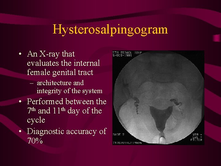 Hysterosalpingogram • An X-ray that evaluates the internal female genital tract – architecture and