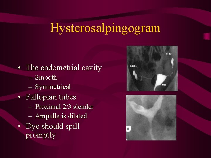 Hysterosalpingogram • The endometrial cavity – Smooth – Symmetrical • Fallopian tubes – Proximal