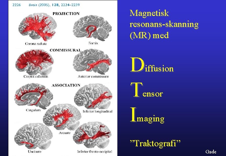 Magnetisk resonans-skanning (MR) med Diffusion Tensor Imaging ”Traktografi” Gade 