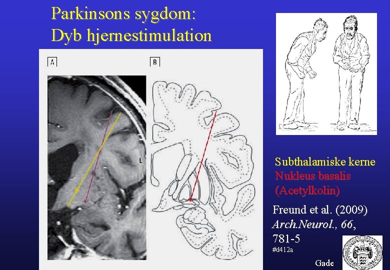 Parkinsons sygdom: Dyb hjernestimulation Subthalamiske kerne Nukleus basalis (Acetylkolin) Freund et al. (2009) Arch.
