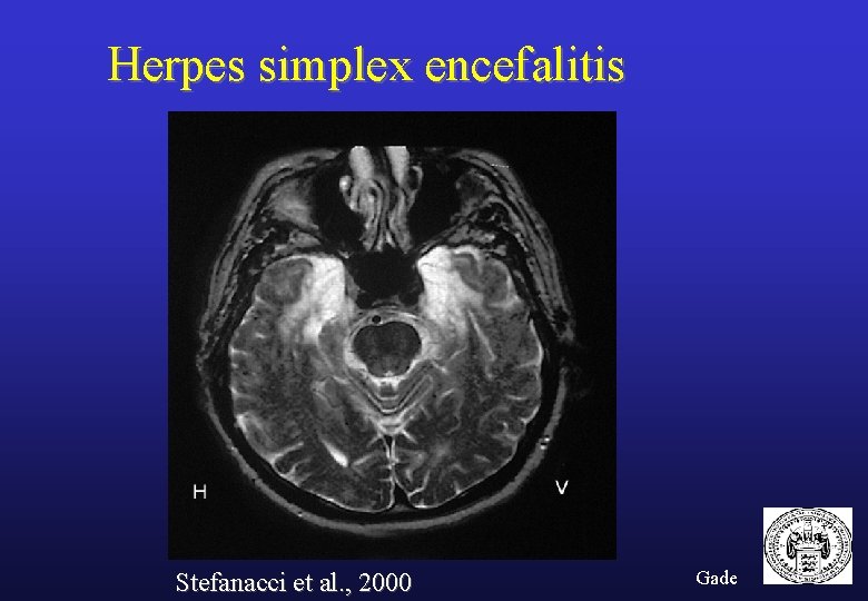 Herpes simplex encefalitis Stefanacci et al. , 2000 Gade 